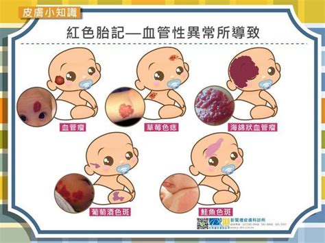 紅色胎記命理|紅色胎記命運大解析